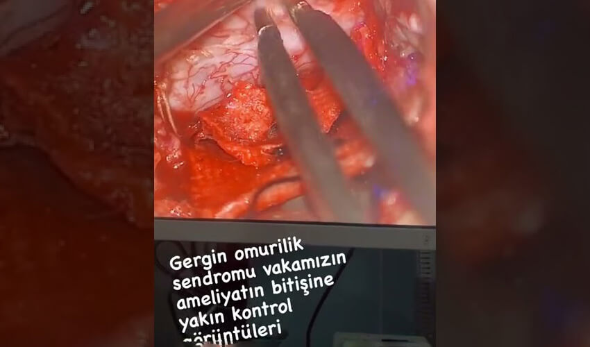 Mikroskop altında omurilik ameliyatı.